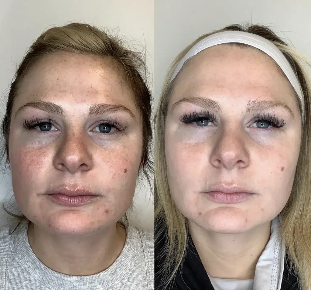 BBL before and after photo by Monroe MedSpa in Rochester, NY