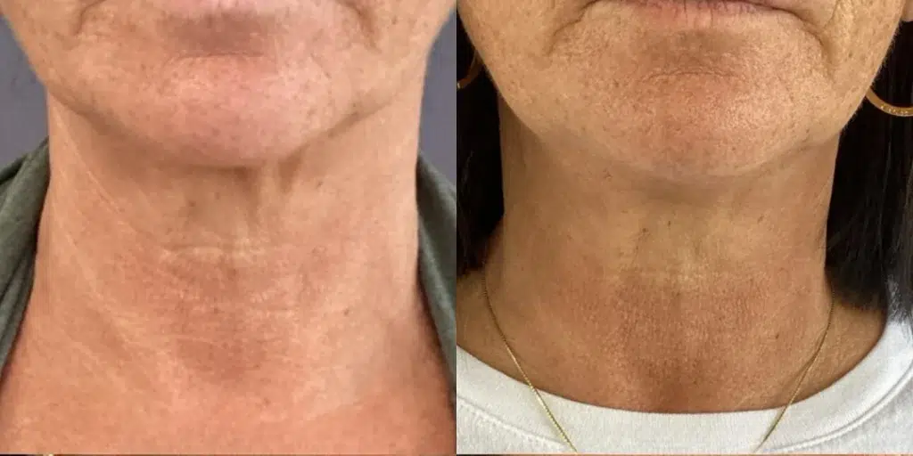 Radiesse before and after photo by Monroe MedSpa in Rochester, NY