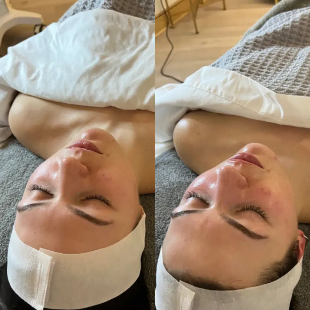 Diamond Glow before and after photo by Monroe MedSpa in Rochester, NY