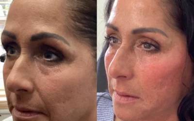 Full Face Rejuvenation before and after photo by Monroe MedSpa in Rochester, NY