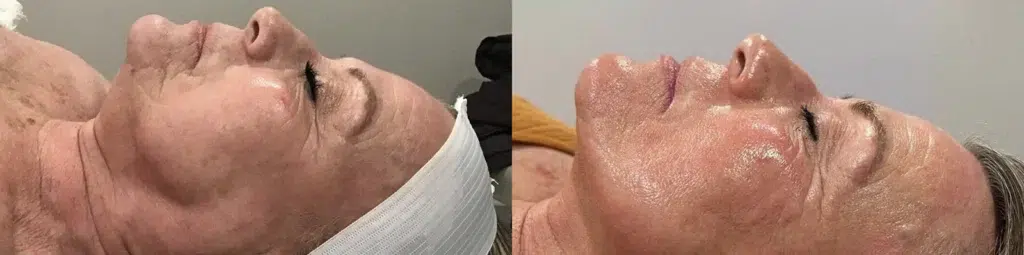 Hydrafacial before and after photo by Monroe MedSpa in Rochester, NY