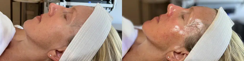 Hydrafacial before and after photo by Monroe MedSpa in Rochester, NY