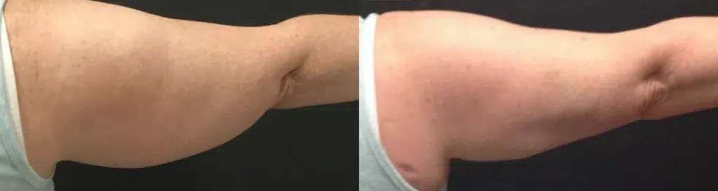 CoolSculpting Elite before and after photo by Monroe MedSpa in Rochester, NY
