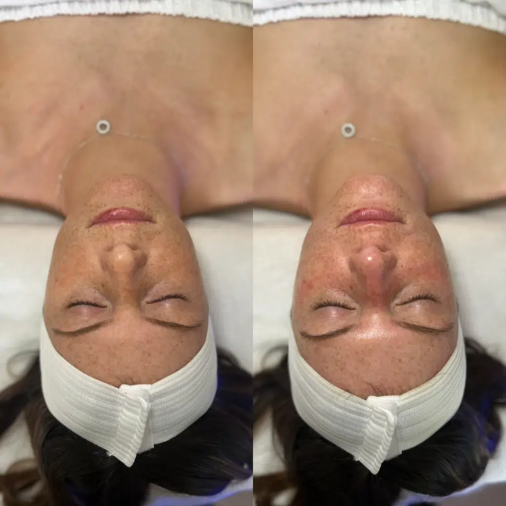 Hydrafacial before and after photo by Monroe MedSpa in Rochester, NY
