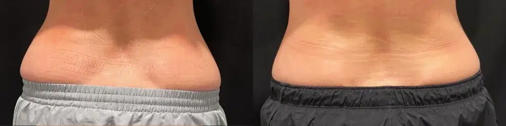 CoolSculpting Elite before and after photo by Monroe MedSpa in Rochester, NY