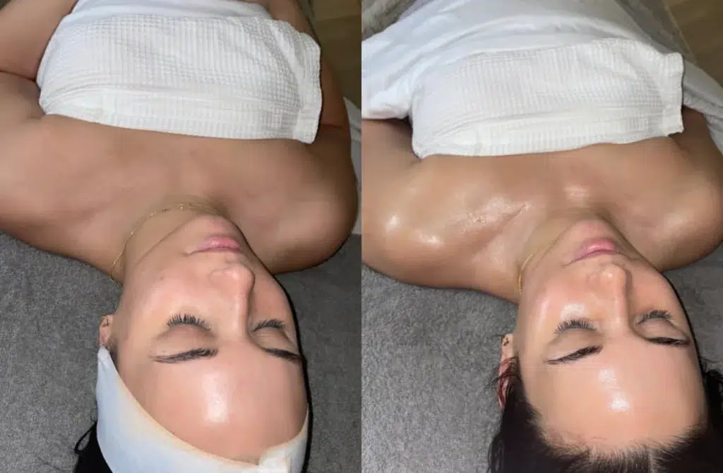 JetPeel before and after photo by Monroe MedSpa in Rochester, NY