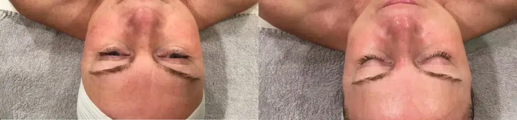 Monroe Customized Facials before and after photo by Monroe MedSpa in Rochester, NY