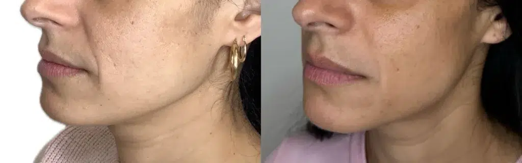 Sculptra before and after photo by Monroe MedSpa in Rochester, NY