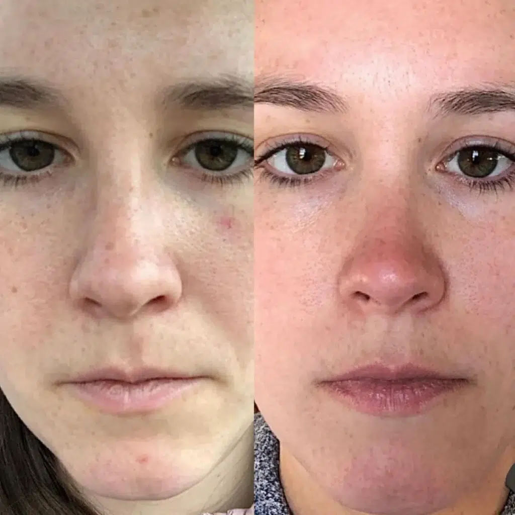 BBL before and after photo by Monroe MedSpa in Rochester, NY