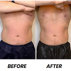 before and after coolsculpting at monroe medspa