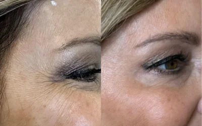 botox dysport before and after photo by monroe medspa in rochester ny x