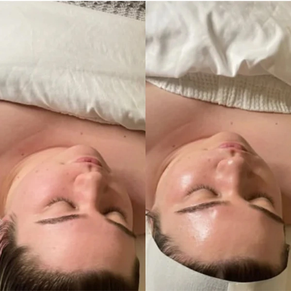 custom facial before and after photo by monroe medspa