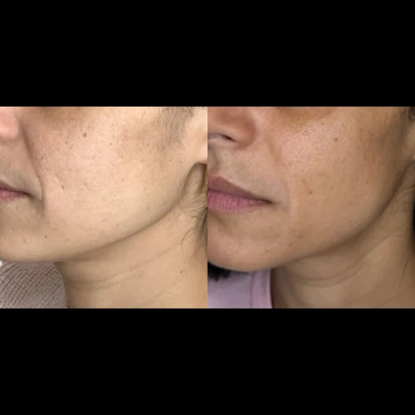 sculptra before and after photo by monroe medspa