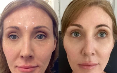 Dermal Fillers before and after photo by Monroe MedSpa in Rochester, NY