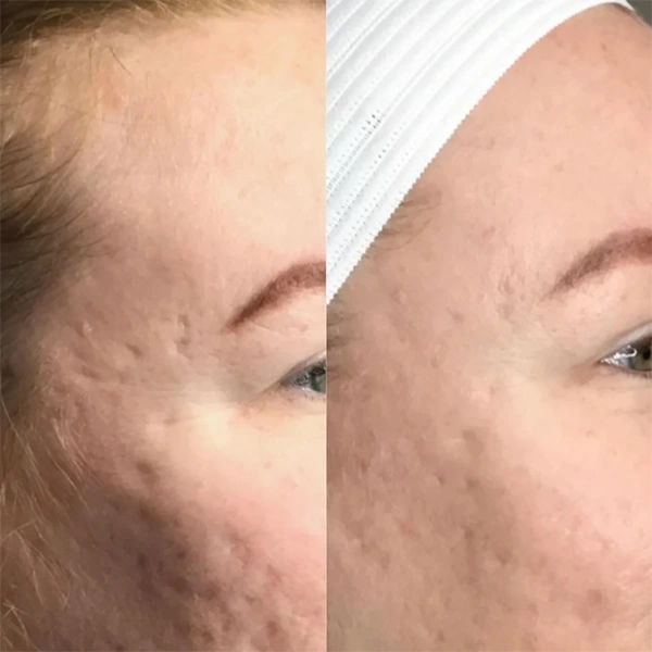 morpheus before and after photo by monroe medspa