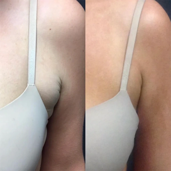 body coolsculpting before and after photo by monroe medspa