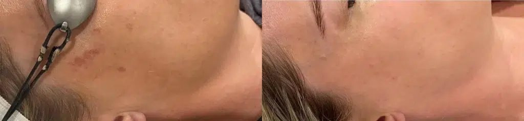 Cynosure Laser (Cuse) before and after photo by Monroe MedSpa in Rochester, NY