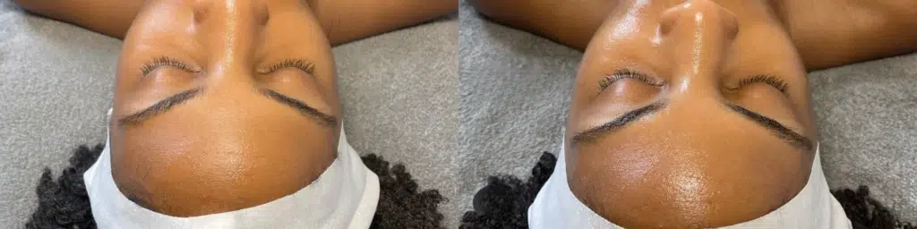 Diamond Glow before and after photo by Monroe MedSpa in Rochester, NY