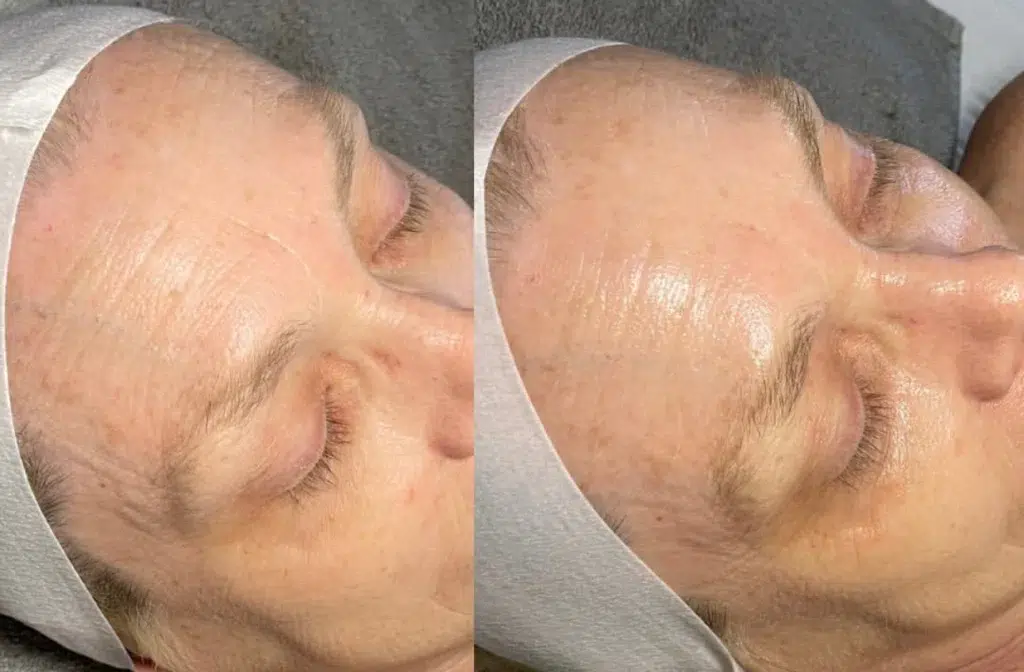 JetPeel before and after photo by Monroe MedSpa in Rochester, NY