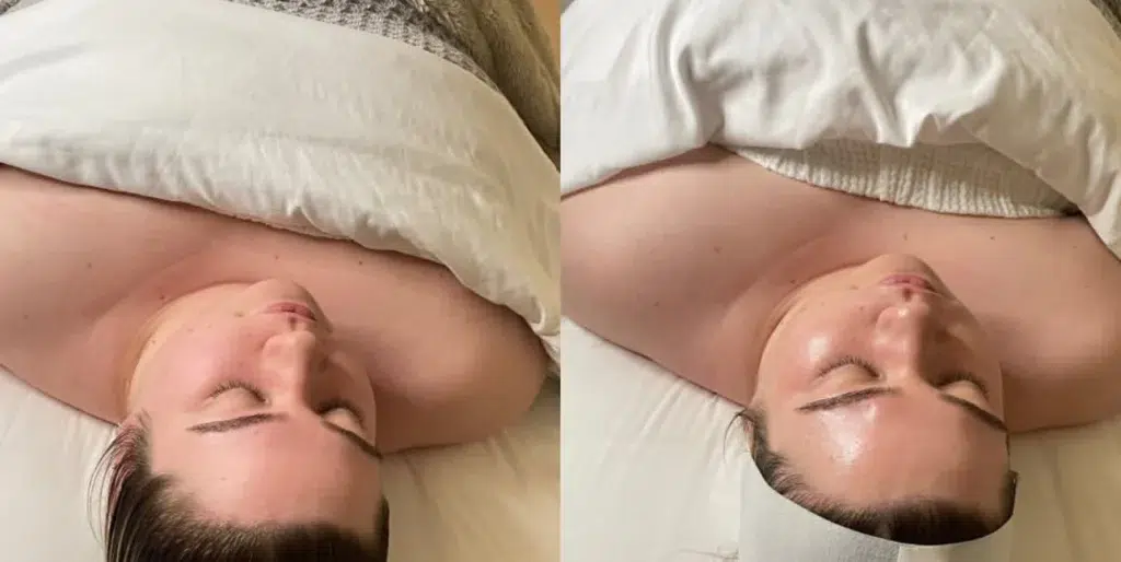 Monroe Customized Facials before and after photo by Monroe MedSpa in Rochester, NY