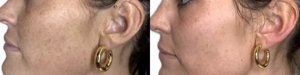 Moxi before and after photo by Monroe MedSpa in Rochester, NY