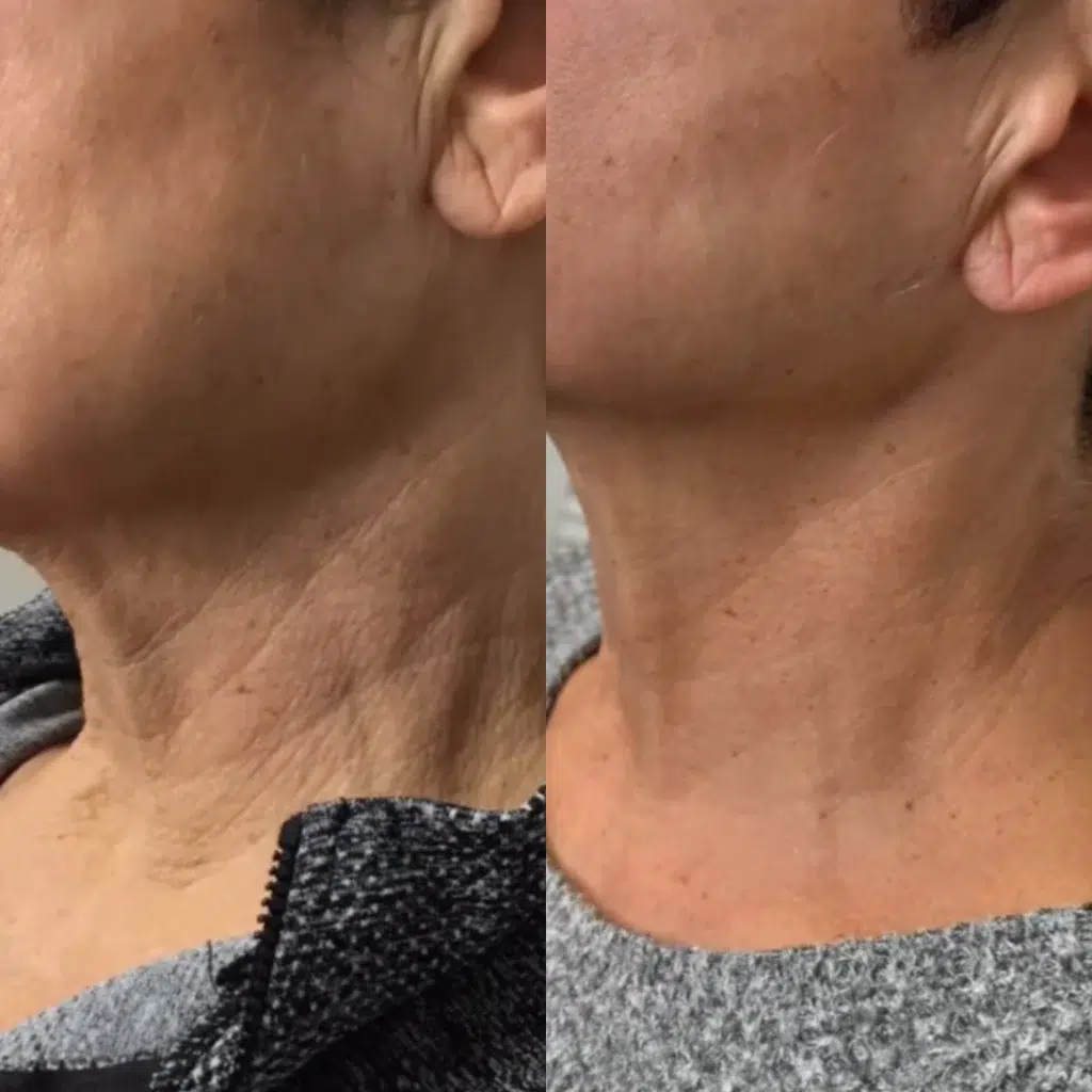 Radiesse before and after photo by Monroe MedSpa in Rochester, NY