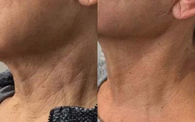 Radiesse before and after photo by Monroe MedSpa in Rochester, NY