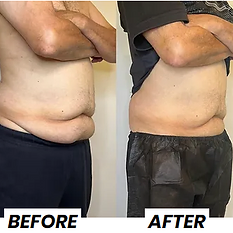 before and after coolsculpting at monroe medspa