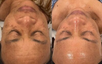 chemical peel before and after photo by monroe medspa in rochester ny x