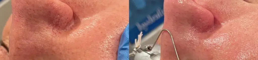 Cynosure Laser (Cuse) before and after photo by Monroe MedSpa in Rochester, NY