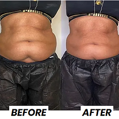 before and after coolsculpting at monroe medspa