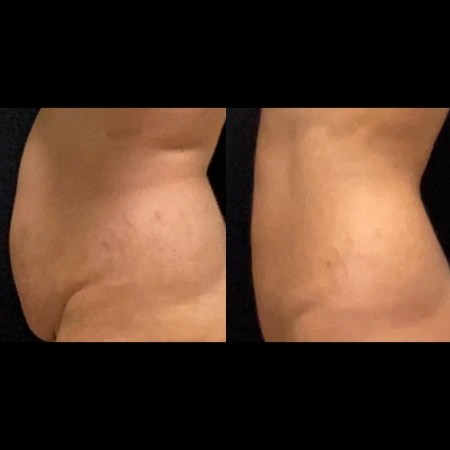 coolsculpting elite before and after photo by monroe medspa in rochester ny