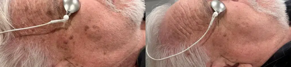 Cynosure Laser (Cuse) before and after photo by Monroe MedSpa in Rochester, NY