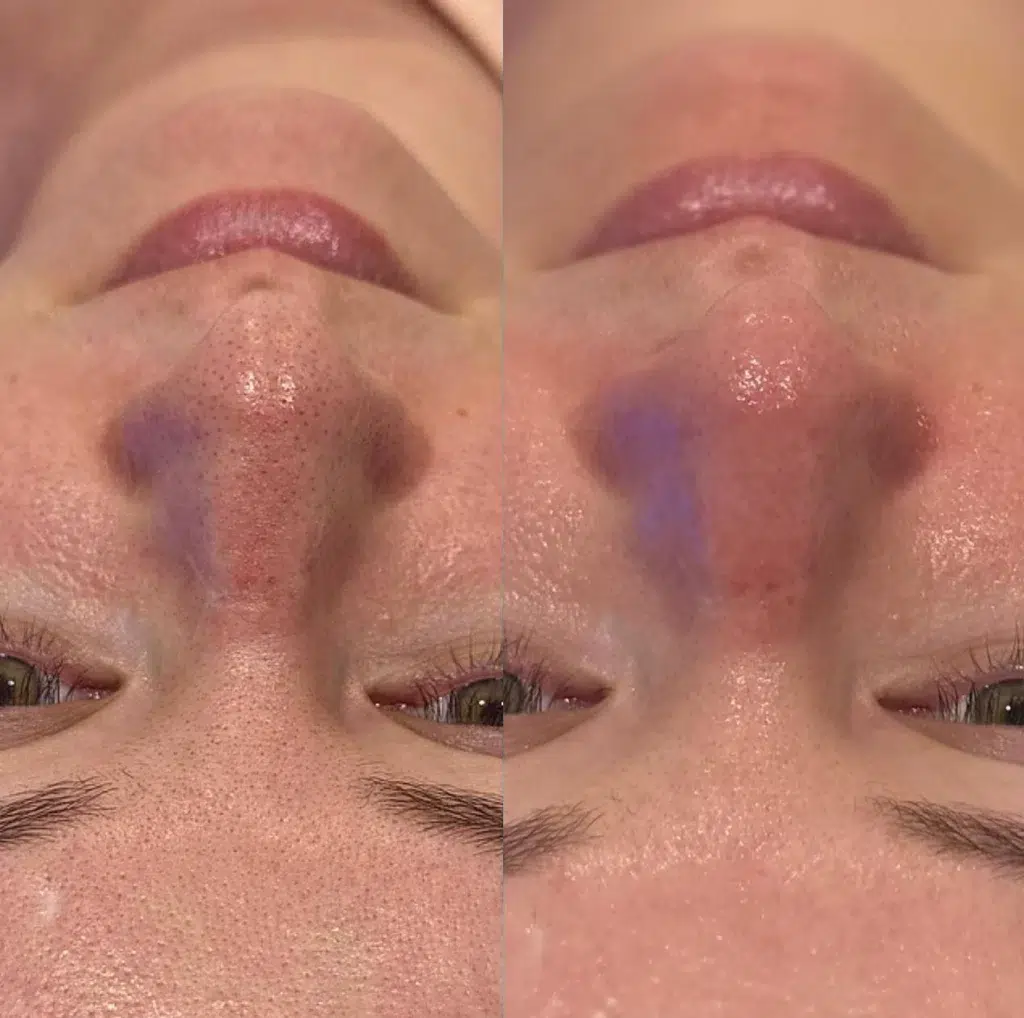 Hydrafacial before and after photo by Monroe MedSpa in Rochester, NY