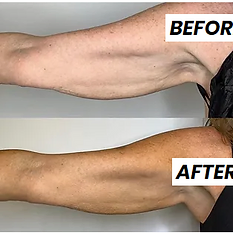 before and after coolsculpting at monroe medspa