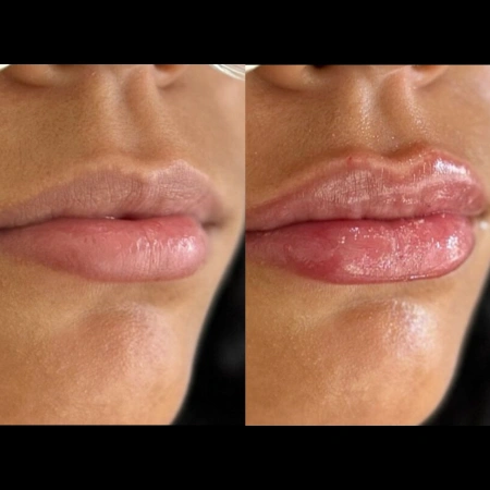 dermal fillers before and after photo by monroe medspa in rochester ny