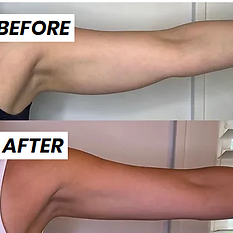 before and after coolsculpting at monroe medspa