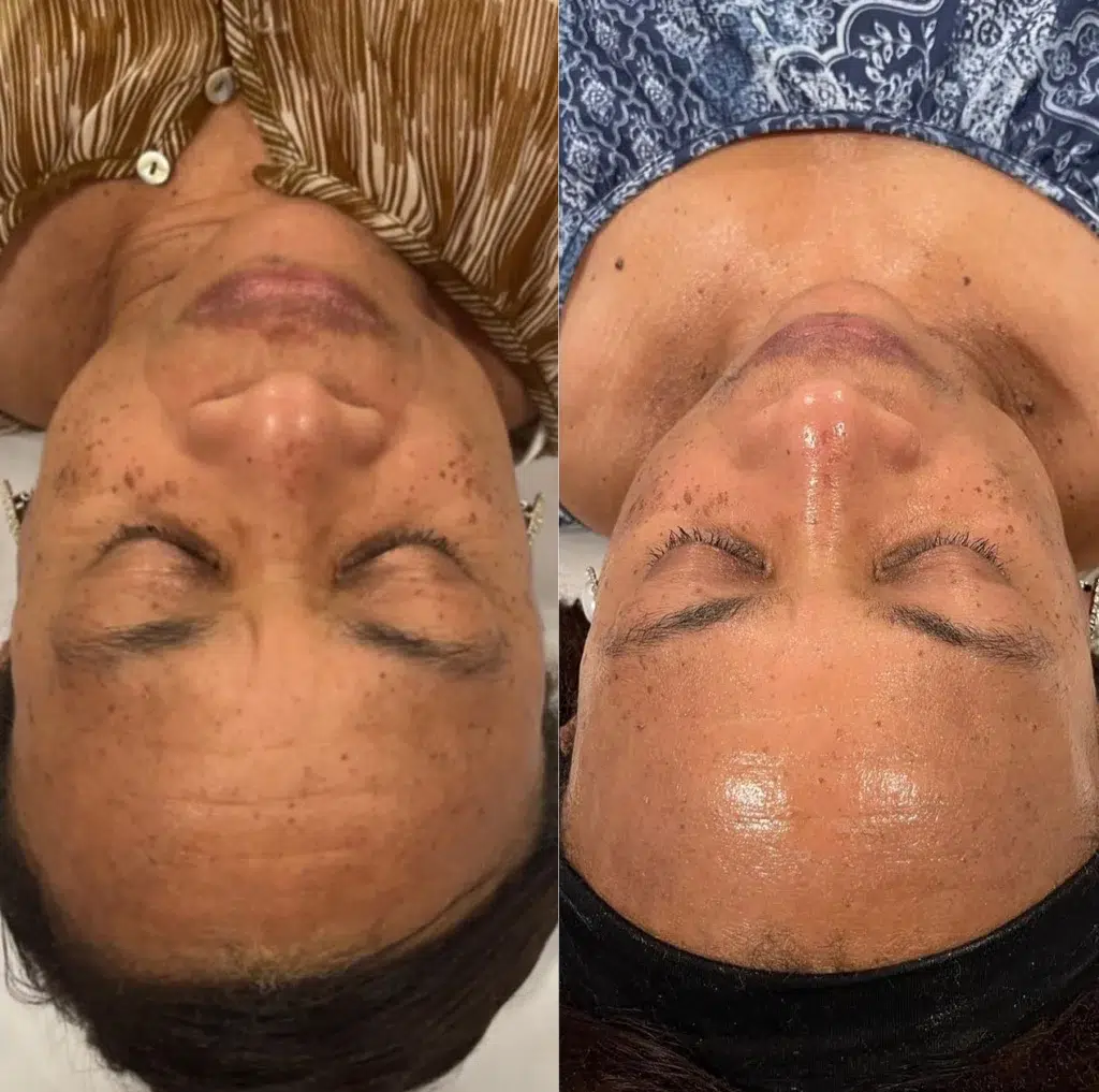 CoolSculpting Elite before and after photo by Monroe MedSpa in Rochester, NY