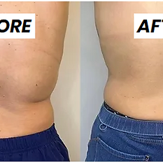 before and after coolsculpting at monroe medspa