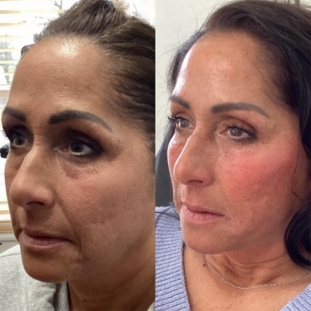 full face rejuvenation before and after photo by monroe medspa in rochester ny