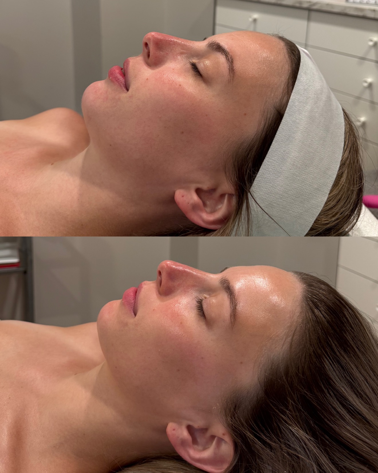 hydrafacial before and after