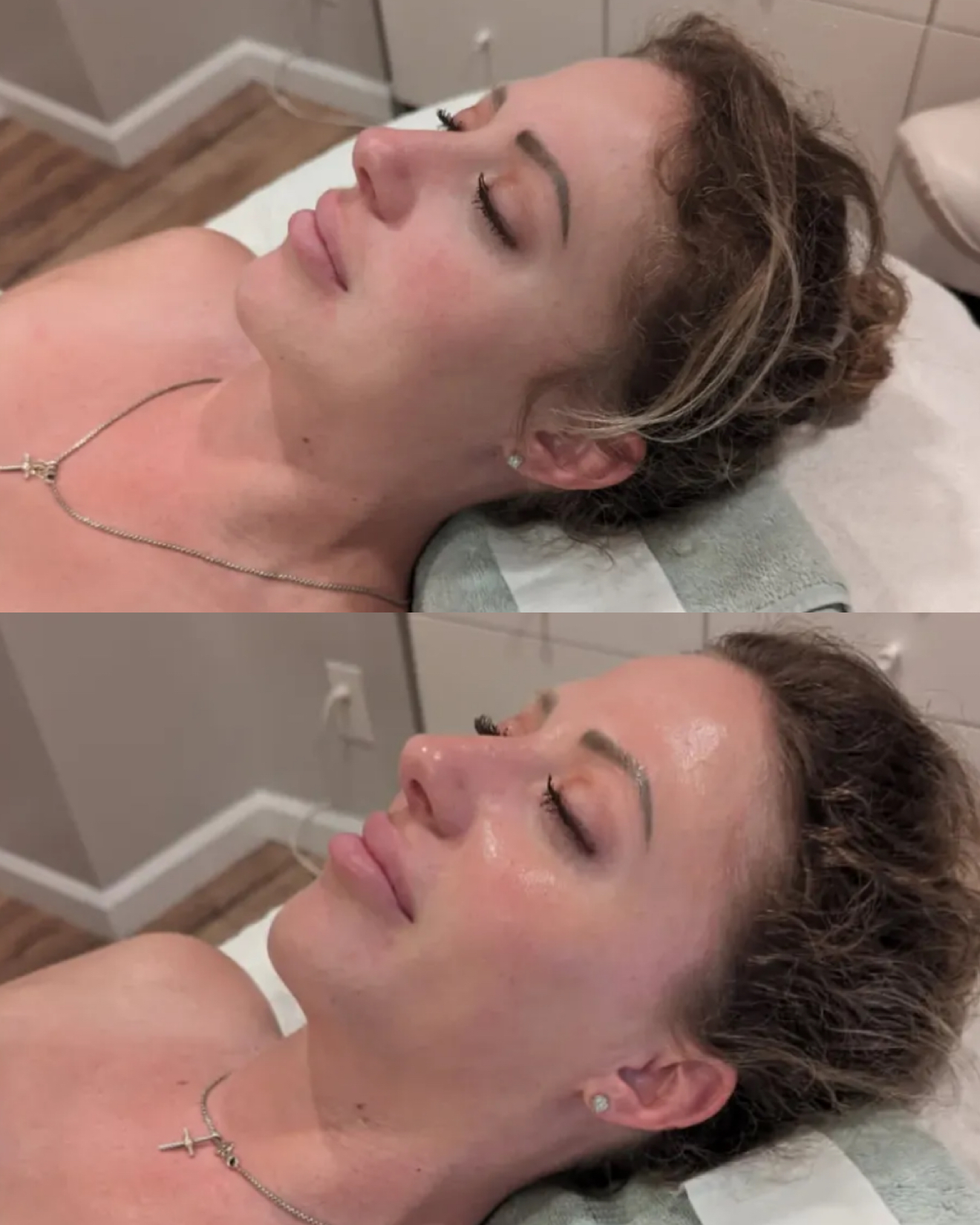 hydrafacial before and after