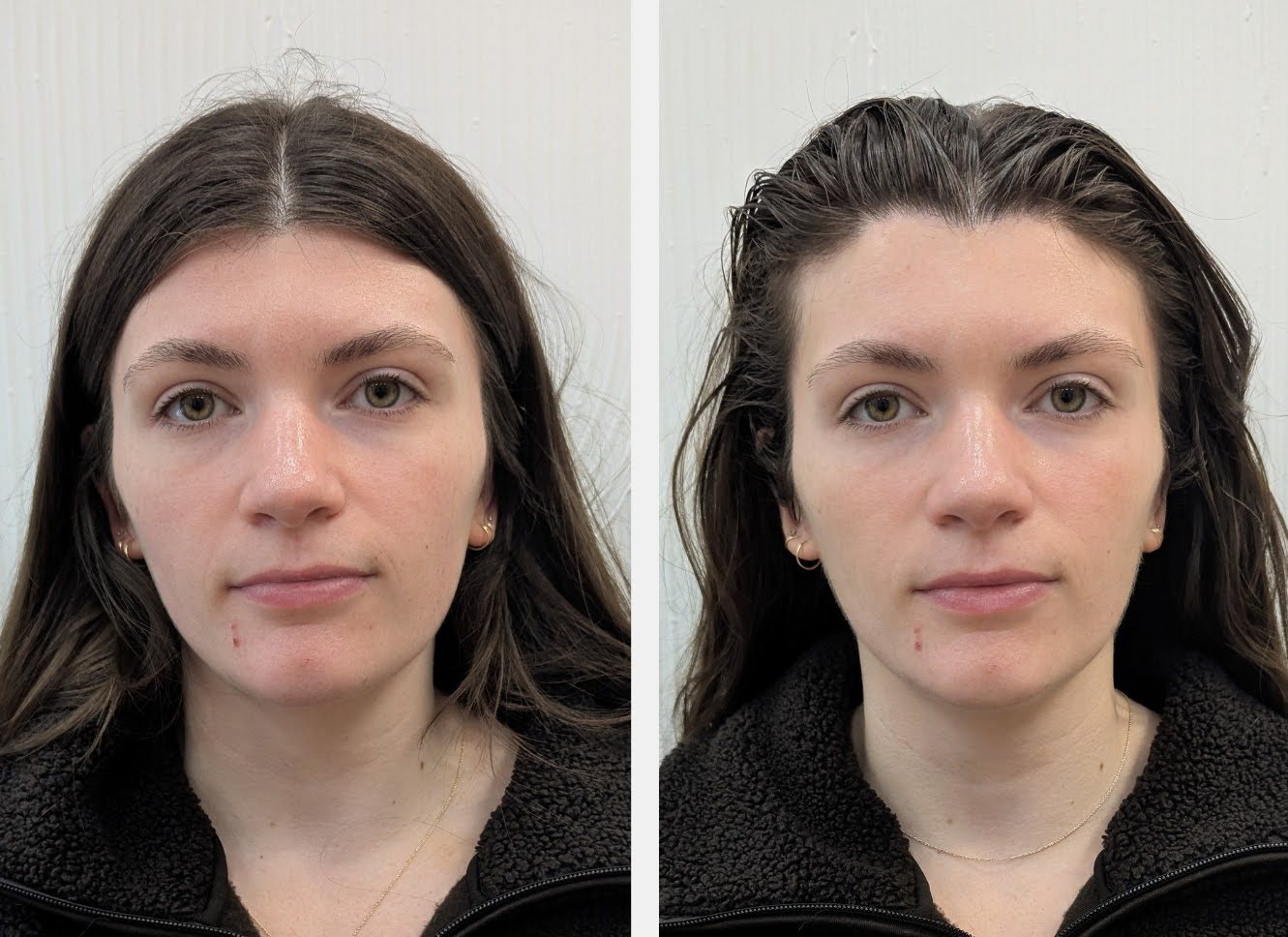 jetpeel before and after by monroemedspa in syracuse