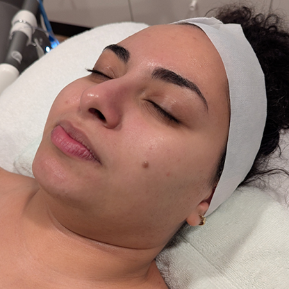 jetpeel before and after by monroemedspa in syracuse