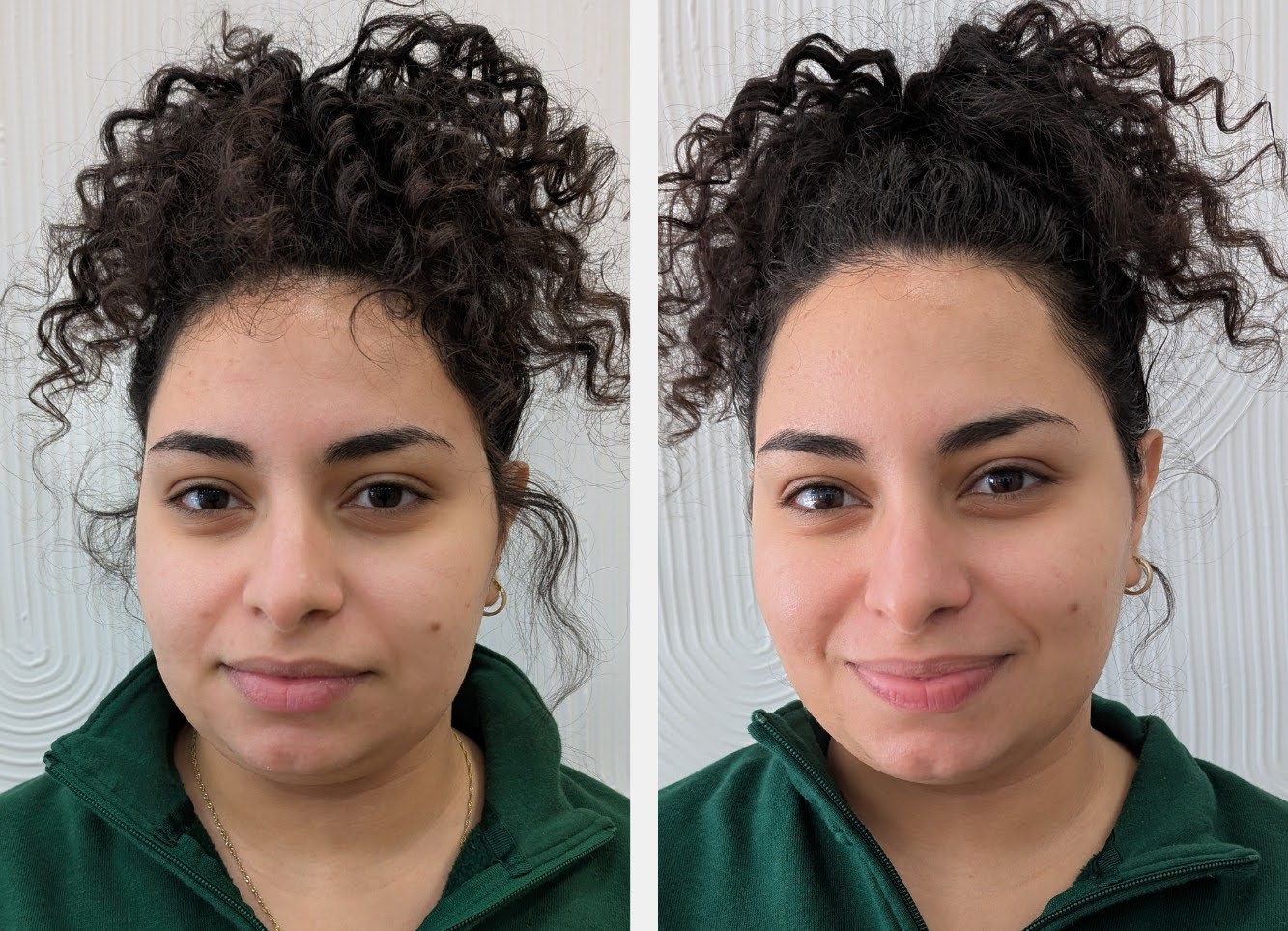 jetpeel before and after by monroemedspa in syracuse